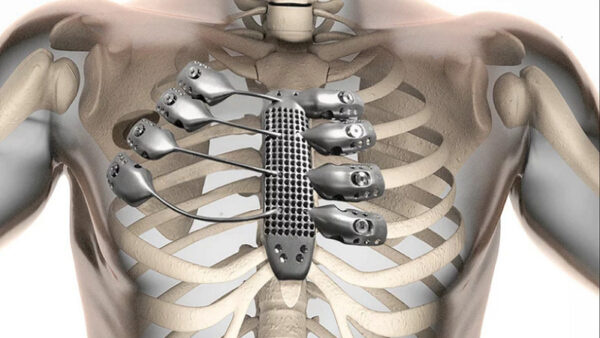 metal titanium skeletal implants